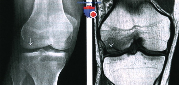Рентгенограмма, КТ, МРТ при субхондральном переломе в коленном суставе