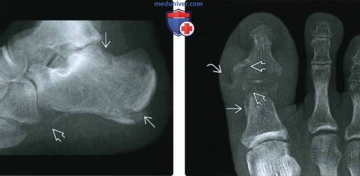 Рентгенограмма, КТ, МРТ суставов и костей при сахарном диабете