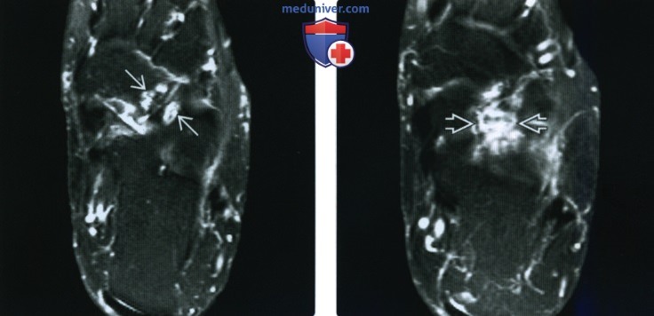 Рентгенограмма, КТ, МРТ при тарзальной коалиции