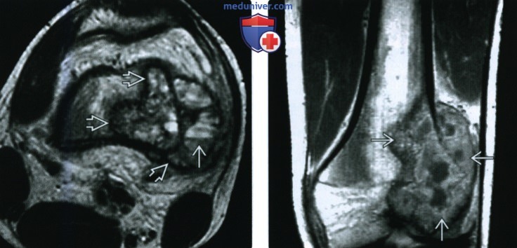 Рентгенограмма, КТ, МРТ при телеангиэктатической остеосаркоме