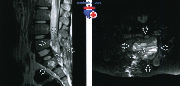 Рентгенограмма, КТ, МРТ при телеангиэктатической остеосаркоме