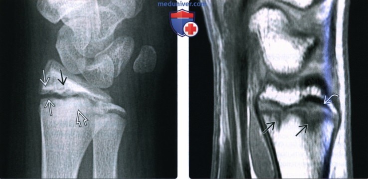 Рентгенограмма, КТ, МРТ при травматическом остеолизе костей лучезапястного сустава у детей