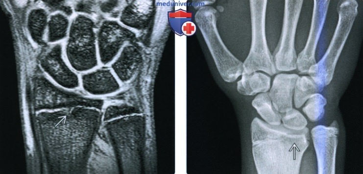 Рентгенограмма, КТ, МРТ при травматическом остеолизе костей лучезапястного сустава у детей