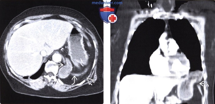 Рентгенограмма, КТ, МРТ при травматическом разрыве диафрагмы