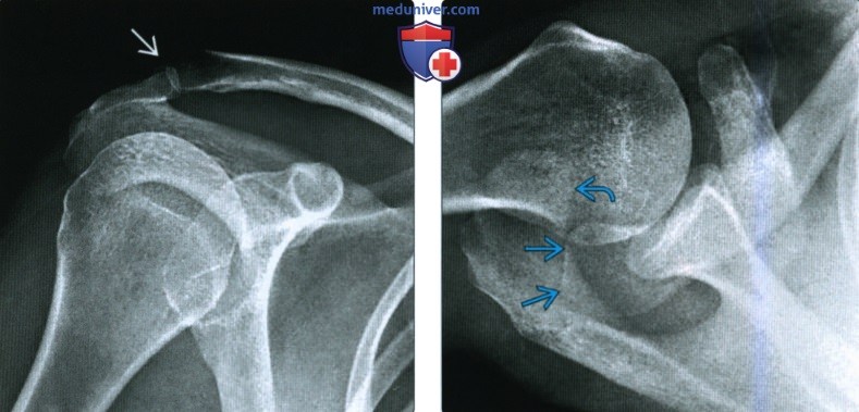 Рентгенограмма, КТ, МРТ при травме акромиально-ключичного сустава