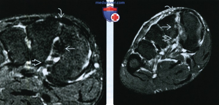 Рентгенограмма, КТ, МРТ при повреждении связки Лисфранка