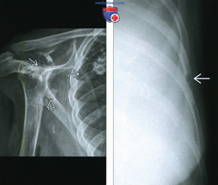 Рентгенограмма, КТ, МРТ при туберкулезе костей и суставов