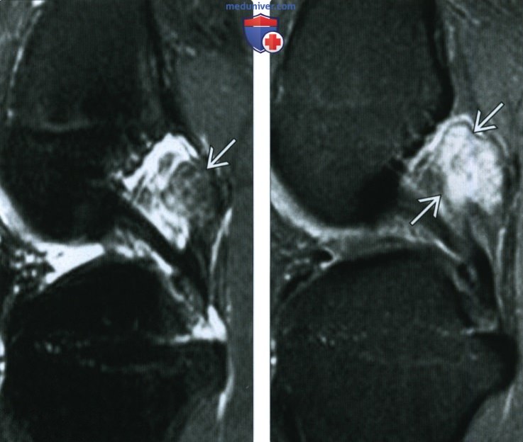 Рентгенограмма, КТ, МРТ при узелковом внутрисуставном синовите