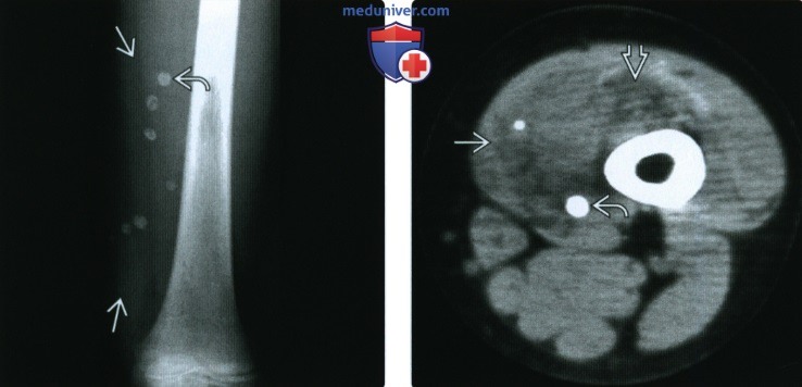Рентгенограмма, КТ, МРТ, УЗИ при гемангиоме мягких тканей