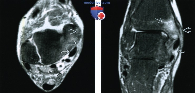 Рентгенограмма, КТ, МРТ, УЗИ при отрыве ужерживателя сгибателей стопы