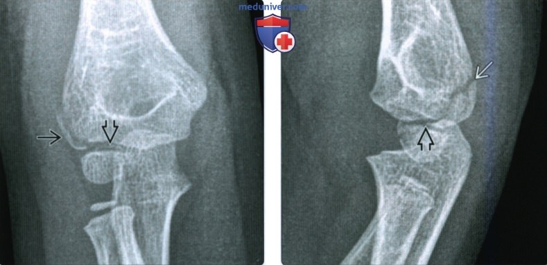 Рентгенограмма, КТ, МРТ, УЗИ при переломе латерального мыщелка локтевого сустава
