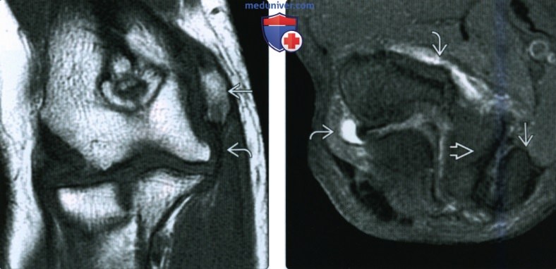Рентгенограмма, КТ, МРТ, УЗИ при переломе медиального мыщелка локтевого сустава