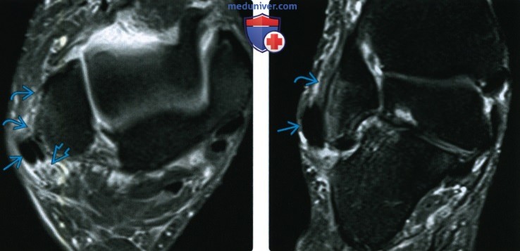 Рентгенограмма, КТ, МРТ, УЗИ при отрывном переломе области прикрепления верхнего удерживателя малоберцовых мышц