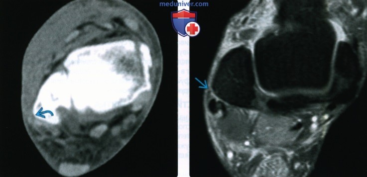 Рентгенограмма, КТ, МРТ, УЗИ при отрывном переломе области прикрепления верхнего удерживателя малоберцовых мышц