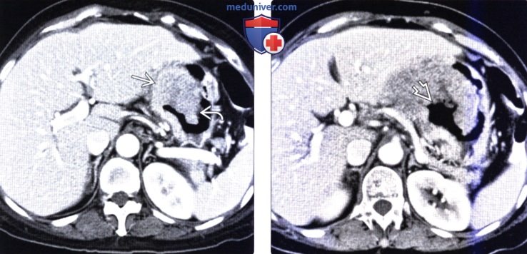 Рентгенограмма, КТ, МРТ, УЗИ, ПЭТ при гастроинтестинальной стромальной опухоли (ГИСО) желудка