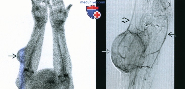 Рентгенограмма, КТ, МРТ, УЗИ при недифференцированной плеоморфной саркоме