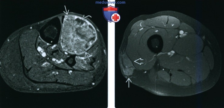 Рентгенограмма, КТ, МРТ, УЗИ при недифференцированной плеоморфной саркоме