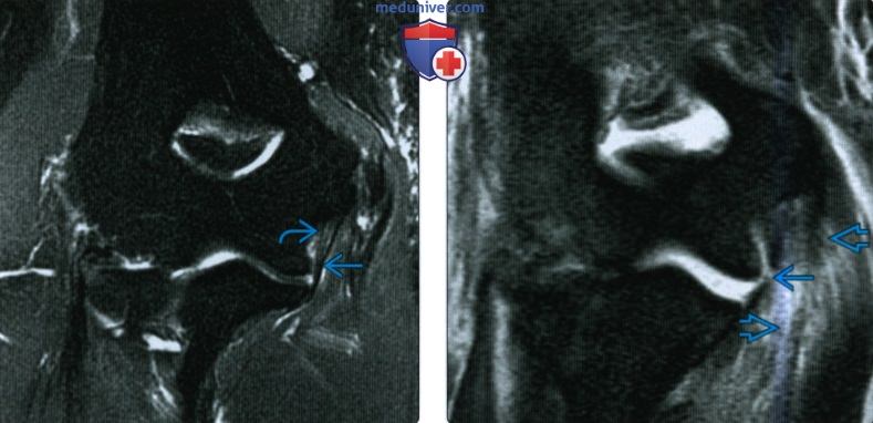 Рентгенограмма, КТ, МРТ, УЗИ при повреждении локтевой коллатеральной связки