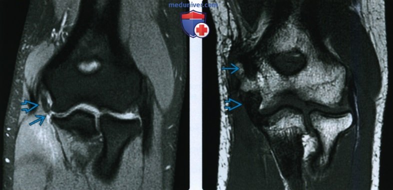 Рентгенограмма, КТ, МРТ, УЗИ при повреждении локтевой коллатеральной связки