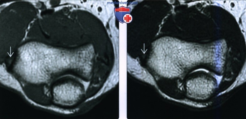 Рентгенограмма, КТ, МРТ, УЗИ при повреждении сухожилия общего разгибателя на уровне локтевого сустава