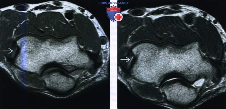 Рентгенограмма, КТ, МРТ, УЗИ при повреждении сухожилия общего разгибателя на уровне локтевого сустава