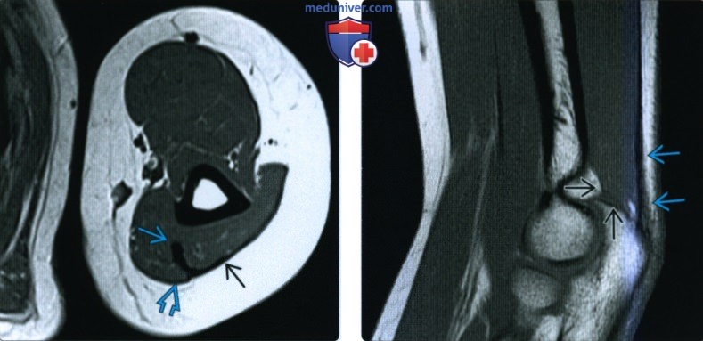 Рентгенограмма, КТ, МРТ, УЗИ при повреждении сухожилия трехглавой мышцы на уровне локтевого сустава