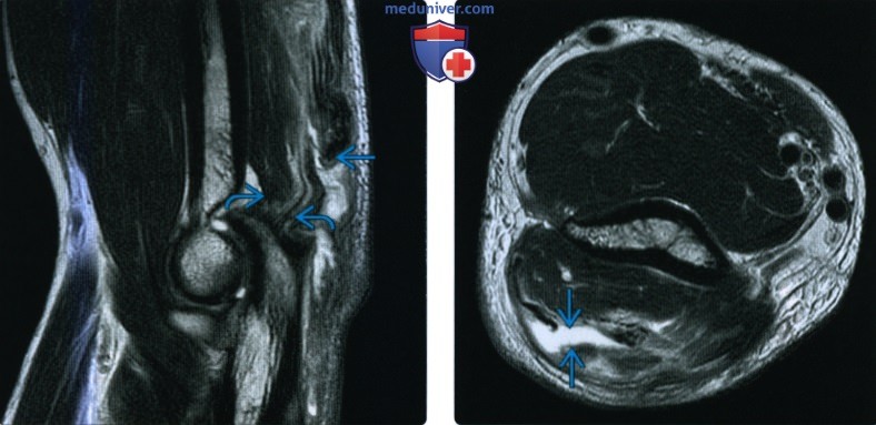 Рентгенограмма, КТ, МРТ, УЗИ при повреждении сухожилия трехглавой мышцы на уровне локтевого сустава