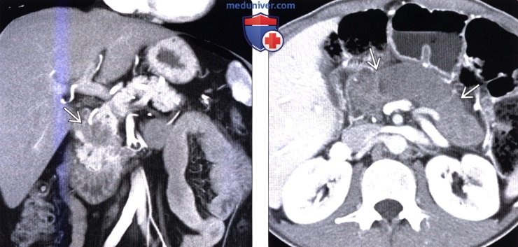 Рентгенограмма, КТ, МРТ, УЗИ при протоковом раке поджелудочной железы