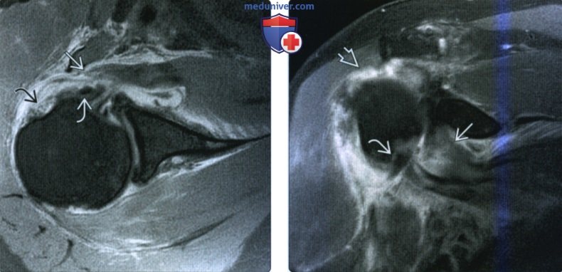 Рентгенограмма, КТ, МРТ, УЗИ при разрыве сухожилия подлопаточной мышцы