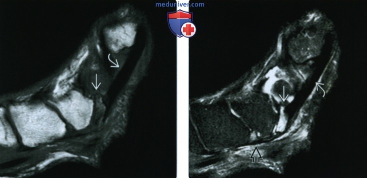 Рентгенограмма, КТ, МРТ, УЗИ при разрыве или тендинопатии сухожилия задней большеберцовой мышцы
