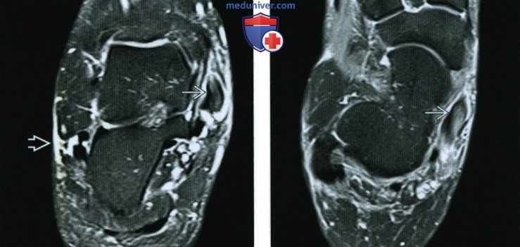 Рентгенограмма, КТ, МРТ, УЗИ при разрыве или тендинопатии сухожилия задней большеберцовой мышцы
