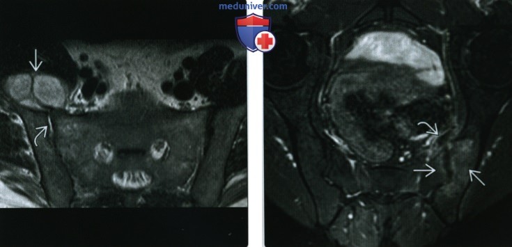 Рентгенограмма, КТ, МРТ, УЗИ при септическом артрите
