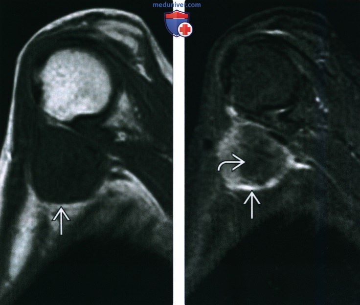 Рентгенограмма, КТ, МРТ, УЗИ при склерозирующей эпителиоидной фибросаркоме