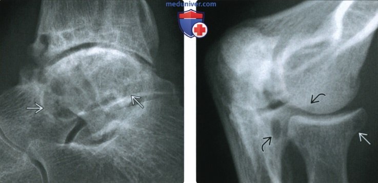 Рентгенограмма, КТ, МРТ, УЗИ суставов и костей при гемофилии