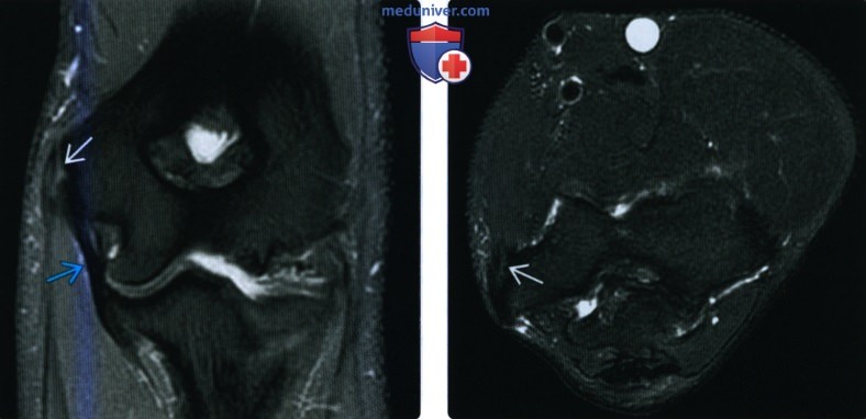 Рентгенограмма, КТ, МРТ, УЗИ при повреждении общего сухожилия сгибателя-пронатора на уровне локтевого сустава