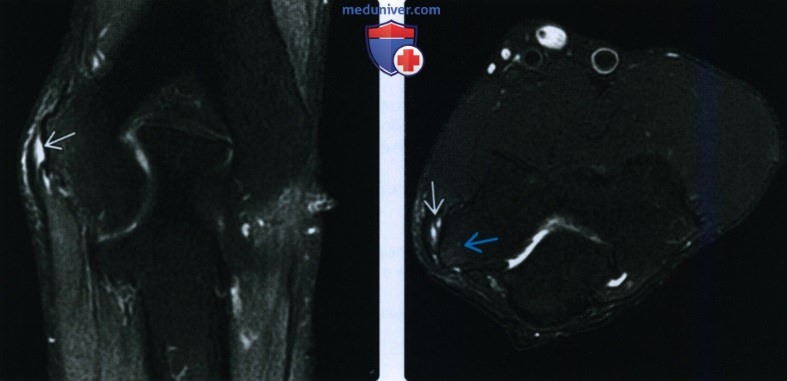Рентгенограмма, КТ, МРТ, УЗИ при повреждении общего сухожилия сгибателя-пронатора на уровне локтевого сустава