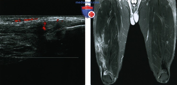 Рентгенограмма, КТ, МРТ, УЗИ при травме четырехглавой мышцы
