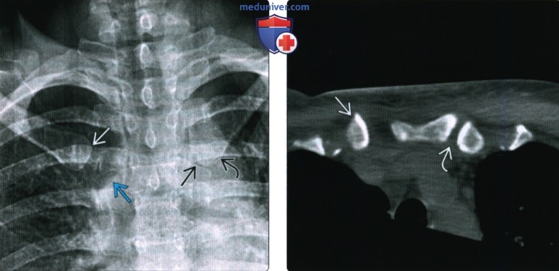 Рентгенограмма, КТ, МРТ, УЗИ при травме грудино-ключичного сустава
