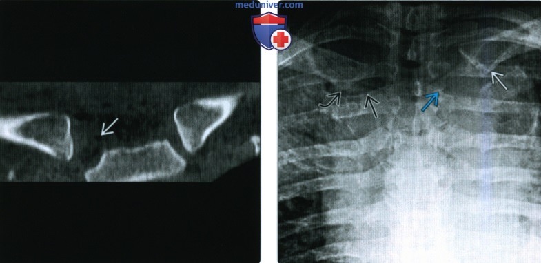 Рентгенограмма, КТ, МРТ, УЗИ при травме грудино-ключичного сустава