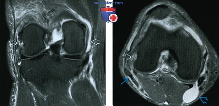 Рентгенограмма, КТ, МРТ, УЗИ при травме латерального коллатерального связочного комплекса коленного сустава
