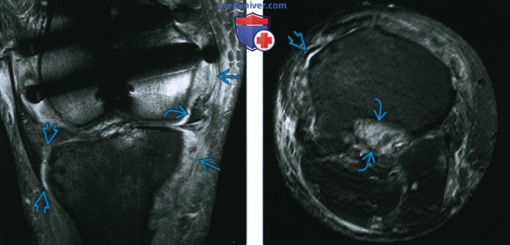 Рентгенограмма, КТ, МРТ, УЗИ при травме латерального коллатерального связочного комплекса коленного сустава
