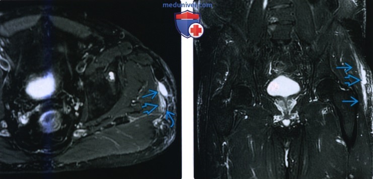 Рентгенограмма, КТ, МРТ, УЗИ при травме вращателей и отводящих мышц бедра