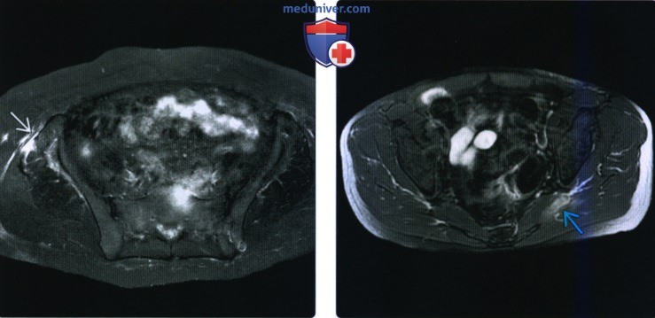 Рентгенограмма, КТ, МРТ, УЗИ при травме вращателей и отводящих мышц бедра