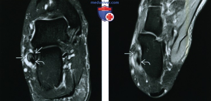 Рентгенограмма, КТ, МРТ, УЗИ при разрыве и тендинопатии сухожилий малоберцовых мышц