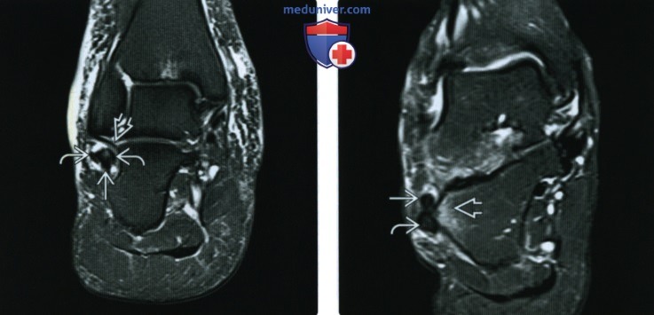 Рентгенограмма, КТ, МРТ, УЗИ при разрыве и тендинопатии сухожилий малоберцовых мышц