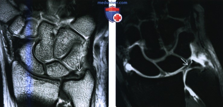 Рентгенограмма, КТ, МРТ, УЗИ при травме треугольного фиброзно-хрящевого комплекса кисти