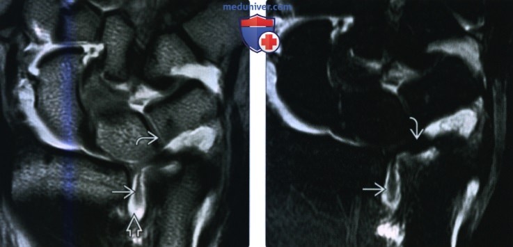 Рентгенограмма, КТ, МРТ, УЗИ при травме треугольного фиброзно-хрящевого комплекса кисти