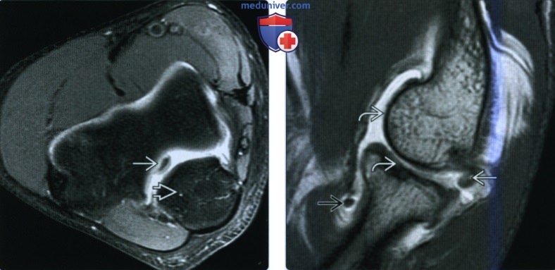 Рентгенограмма, КТ, МРТ, УЗИ при внутрисуставном теле локтевого сустава