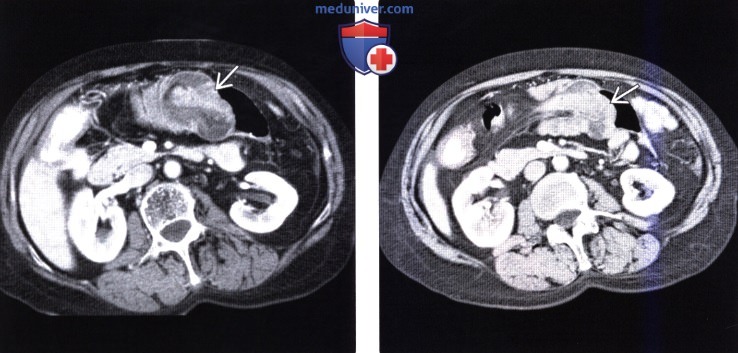 Рентгенограмма, КТ, МРТ, УЗИ при ворсинчатой аденоме