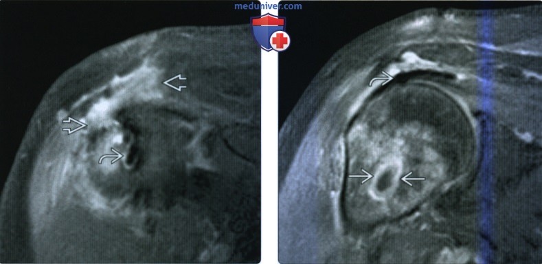 Рентгенограмма, КТ, МРТ, УЗИ при послеоперационном восстановлении ротаторной манжеты